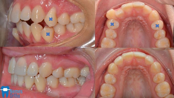 Orthodontic dentition