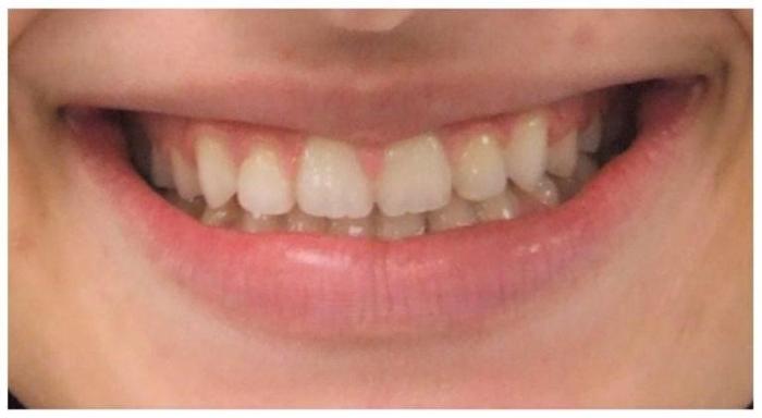 Comprehensive orthodontic treatment of the transitional dentition